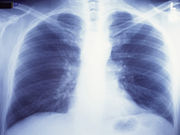 For patients with early-stage small-cell lung cancer undergoing resection