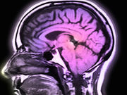 A case report published online Jan. 4 in JAMA Neurology highlights a neuropsychological test profile conducted on a patient with chronic traumatic encephalopathy.