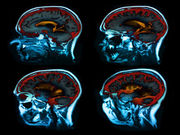 Magnetic resonance imaging brain scans may help identify coma patients who are most likely to regain consciousness