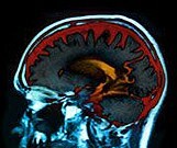 Childhood neglect is associated with changes in the brain's white matter