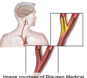 Mortality risk in older Medicare patients who undergo carotid artery stenting is high