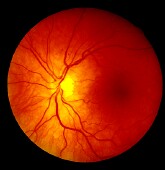 The Mediterranean diet may protect against diabetic retinopathy