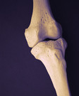 For patients with knee osteoarthritis