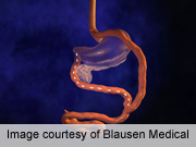 Roux-en-Y gastric bypass surgery strongly predicts insulin cessation after surgery in insulin-treated type 2 diabetes patients