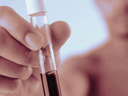 A simple blood test may be an inexpensive