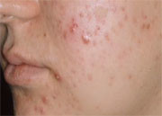 The majority of oral antibiotic course durations for adult acne follow guidelines