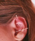 Acupuncture seems feasible for treatment of women with vulvodynia
