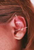 Acupuncture seems feasible for treatment of women with vulvodynia