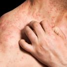 Adults with eczema have a major health burden with significantly increased health care utilization and costs
