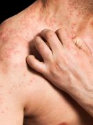 Habit reversal seems to be beneficial for reducing scratching among patients with atopic dermatitis