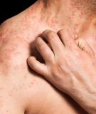 Adults with eczema may also have an increased risk of heart disease and stroke