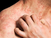 New gene variants associated with eczema have been identified. The new findings