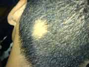 For patients with alopecia areata