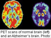 Damage to the brain's white matter may be an early sign of certain types of Alzheimer's disease