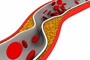 Patients with peripheral arterial disease who face amputation of a foot or leg can have their limb saved by minimally invasive surgery to improve blood flow