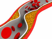 Combination therapy of endovascular revascularization and supervised exercise is associated with greater improvements than supervised exercise alone for patients with intermittent claudication. The findings were published in the Nov. 10 issue of the Journal of the American Medical Association