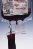 Blood that's been stored for a few weeks is just as beneficial as fresh blood for patients with life-threatening conditions who require transfusions