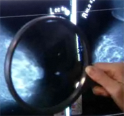 Computer-aided detection added to mammography may not improve breast cancer detection