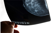 Only 3 percent of women diagnosed with ductal carcinoma in situ will die of breast cancer within 20 years
