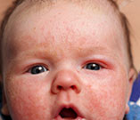 For infants with atopic dermatitis