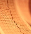 Most patients with atrial fibrillation (AF) and systolic heart failure who undergo ablation have AF recurrence at five years