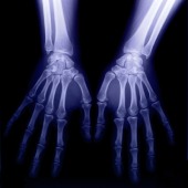 Overweight and obesity are associated with increased risk of carpal tunnel syndrome