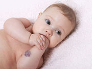 The incidence of infantile hemangiomas has increased over the past three decades