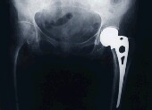 Patients undergoing surgery for hip fracture have a higher risk of mortality and major complications than those receiving an elective total hip replacement