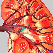 Patients with small renal masses who have a radical nephrectomy are significantly more likely to experience up staging to a more advanced chronic kidney disease stage based on glomerular filtration rate ranges