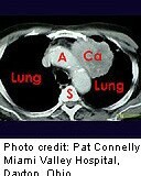 Use of the American College of Radiology Lung Imaging Reporting and Data System classification system for low-dose computed tomography can reduce the false-positive result rate but also decreases sensitivity