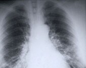 Two experimental drugs may help patients whose lung cancer has become resistant to the latest available treatments
