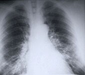 Stage IV nonsmall-cell lung cancer patients in the United States often receive more radiation therapy than recommended