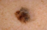 The incidence of melanoma is falling among American children