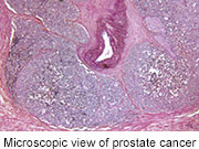For patients with prostate cancer