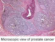 More than one-quarter of patients with metastatic prostate cancer present with a synchronous second primary malignancy