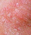 Misconceptions of infection and contagion surround psoriasis