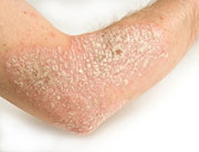 Most patients with moderate to severe plaque psoriasis are prescribed medications