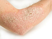 Helicobacter pylori (H. pylori) infection may affect the severity of psoriasis