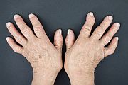 For patients with rheumatoid arthritis with prior biologic exposure