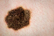 Not all melanoma patients need surgery to remove lymph nodes surrounding their tumor