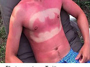 Experts are speaking out against "sunburn art