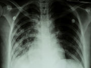 Foreign-born students in the United States have a higher case rate of tuberculosis than other foreign-born individuals