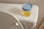 Scientists report that they have developed a urine test that may detect pancreatic cancer at an early stage. The findings were published in the Aug. 1 issue of <i>Clinical Cancer Research</i>.