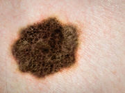 For patients with suspected malignant melanoma or squamous cell carcinoma