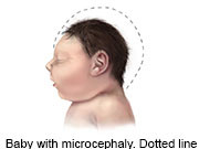 Zika virus is a definite and direct cause of microcephaly and other brain-related birth defects