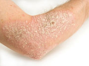 Psoriasis may be linked to excess weight and type 2 diabetes