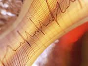 Risk of heart failure appears high within a few years of a first myocardial infarction