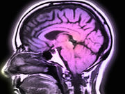 Teens with type 2 diabetes may have differences in gray matter in their brains