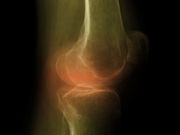 For patients with knee osteoarthritis