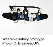 A wearable artificial kidney may be an upcoming option for dialysis patients